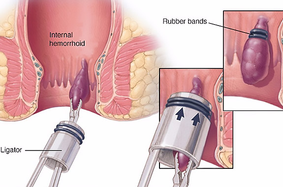 Hemorrhoid Surgery