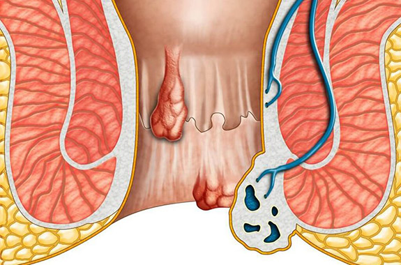 Symptoms & Causes of Hemorrhoids