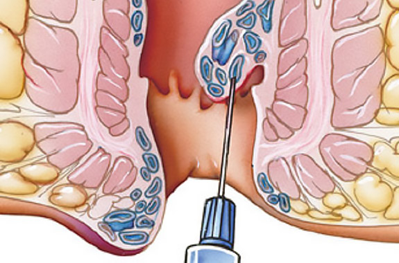 Diagnosis & Treatment of Hemorrhoids